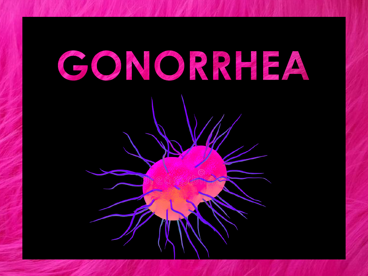 GONORRHEA