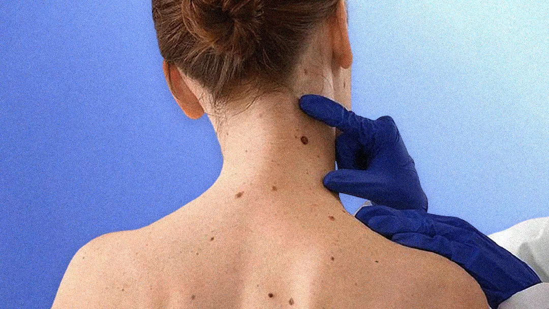 Viral Wart Cryotherapy Treatment in Bangkok, Thailand