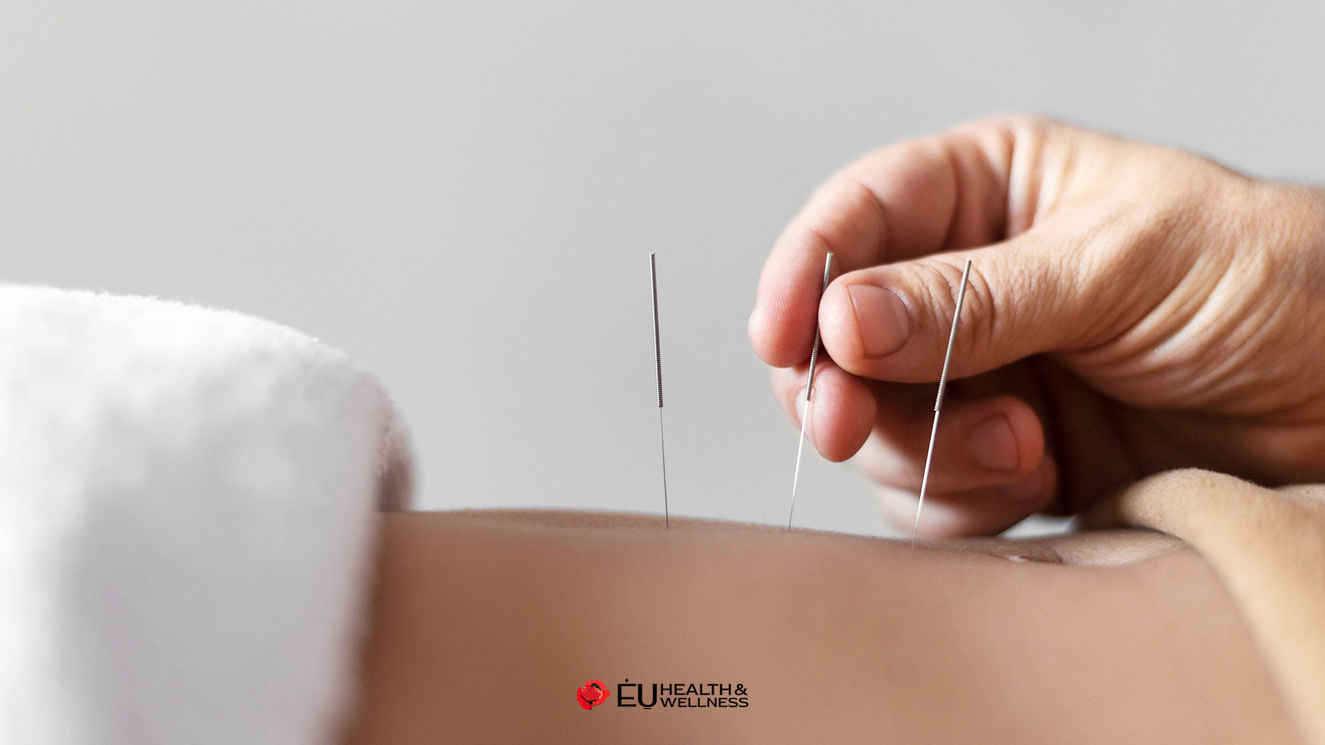 Acupuncture